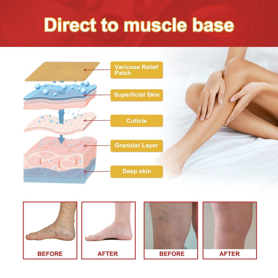 Parche para Varices (6und)