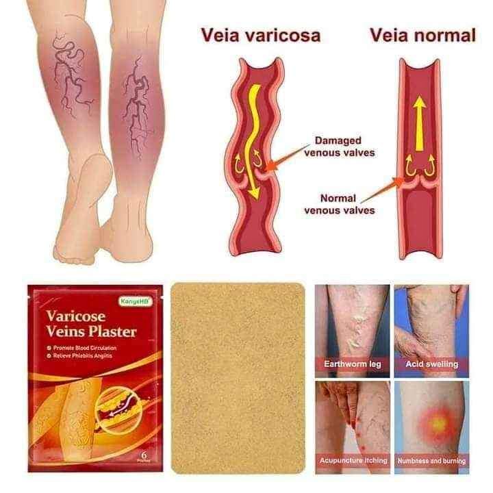 Parche para Varices (6und)